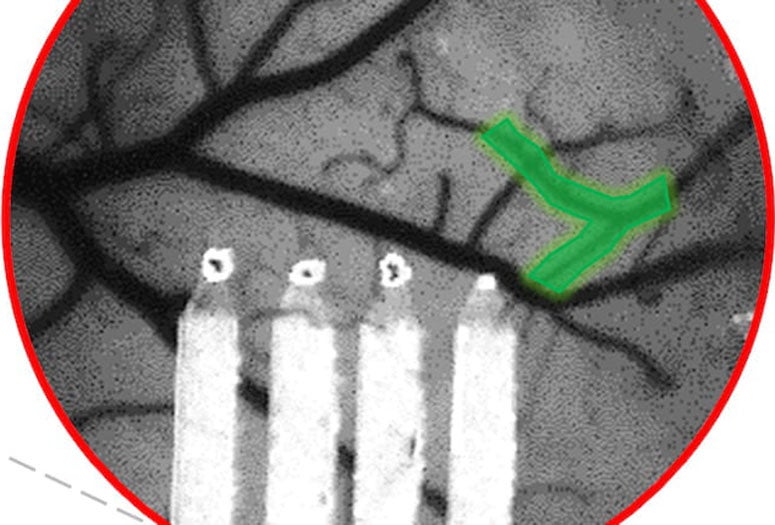 Rice neurobiologists show that increased blood flow to the brain is not an accurate indicator of neuronal recovery after a microscopic stroke. The researchers created a custom implant that combines the ability to simultaneously monitor both blood flow and brain activity. (Credit: Luan Laboratory/Rice University)