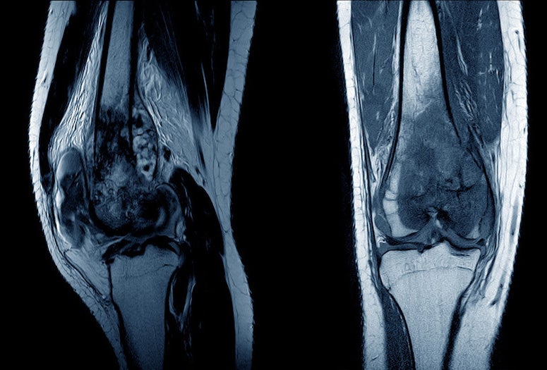 osteosarcoma