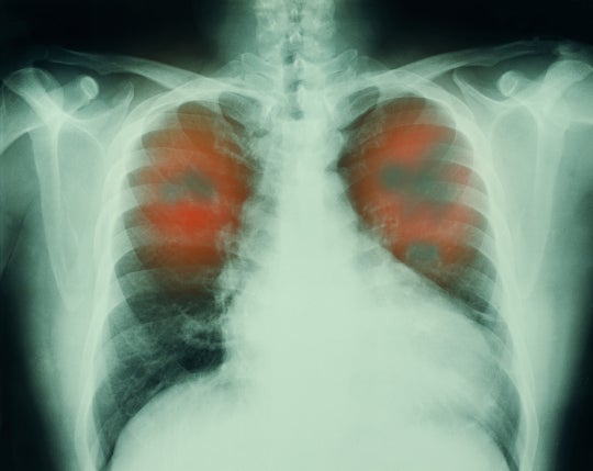 Lung Xray